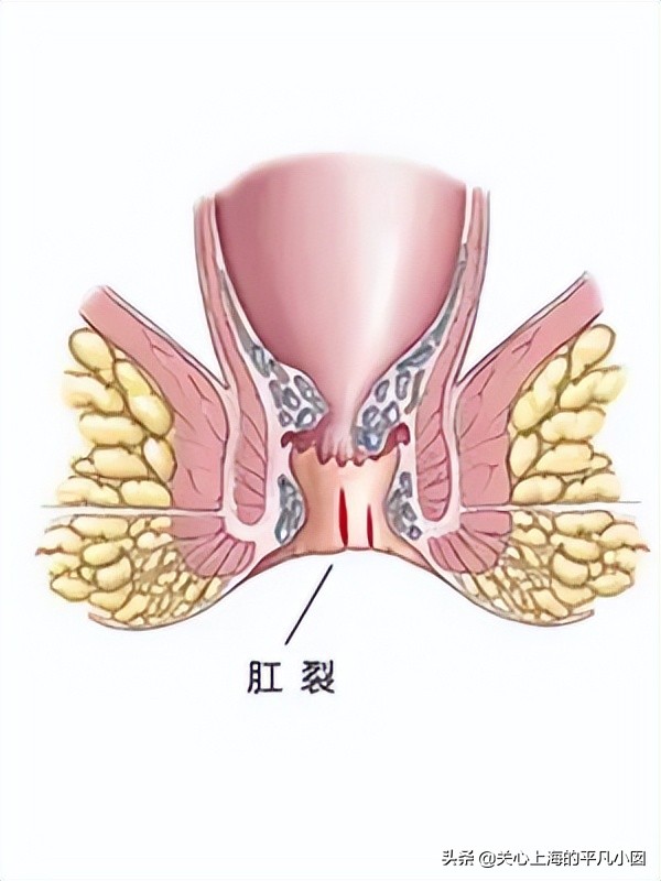 痔疮肛门裂老痛怎么治,肛门小尾巴痛是痔疮吗