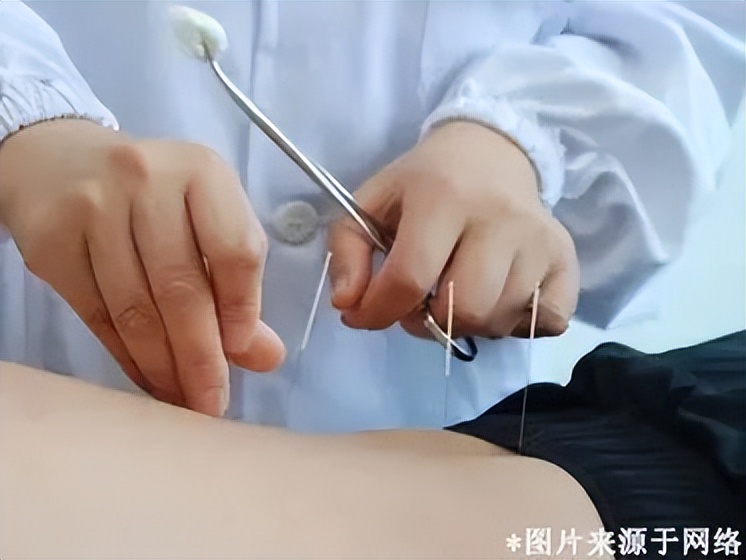 中医手指扎针放血,针灸治疗手颤神奇案例