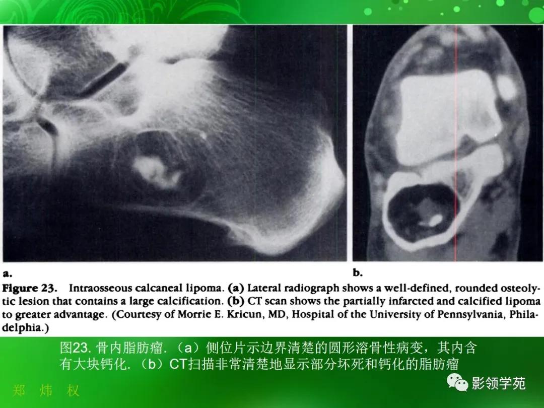 正常跟骨影像图,跟骨正常与变异影像表现图片