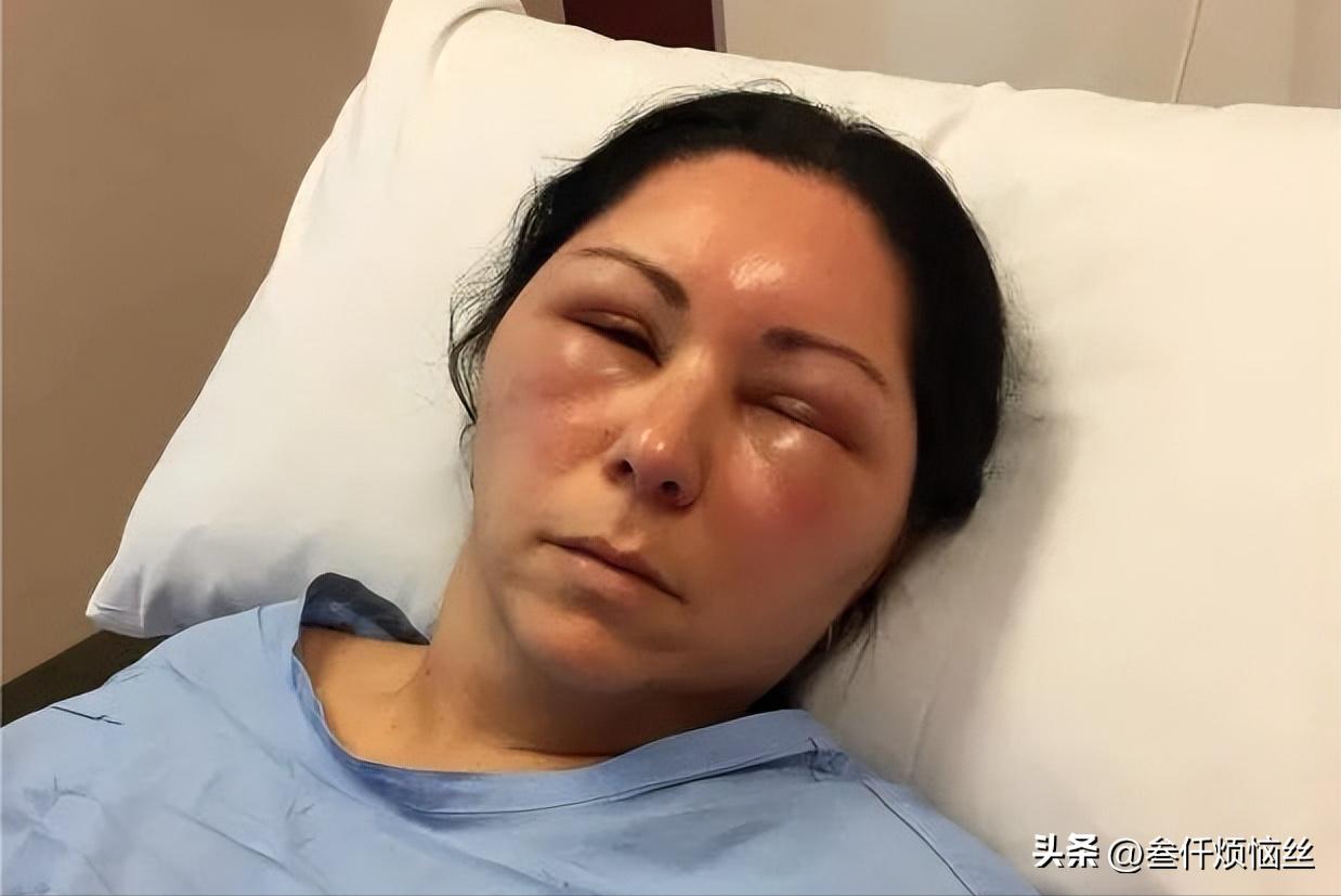 头发过敏用什么染发剂,染发剂过敏的一个现象