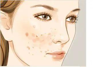 对脸上痘印消除特别有效的方法,痘印和痘坑用什么方法彻底祛除