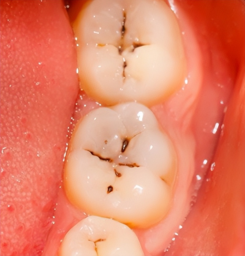 牙齿掉了一块怎么办？需要拔牙吗？