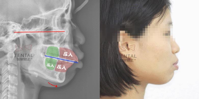 骨性上颌前凸嘴怎么矫正,厚嘴唇与嘴凸有关吗
