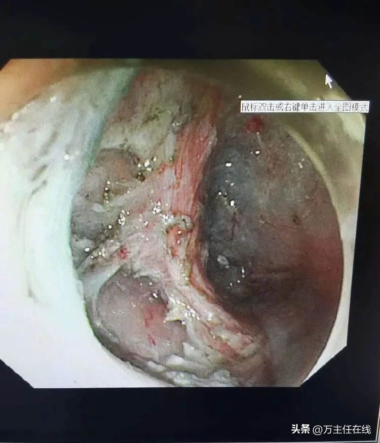 万荣教授上海市第一人民医院,消化内科专家手术