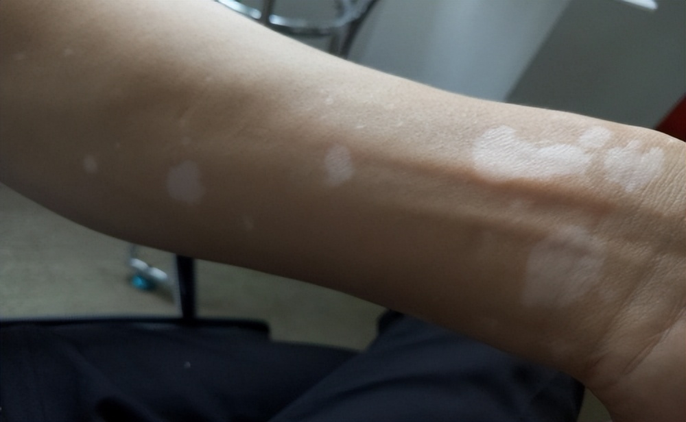 白癜风治疗花钱多吗,白癜风治疗已经花了很多钱