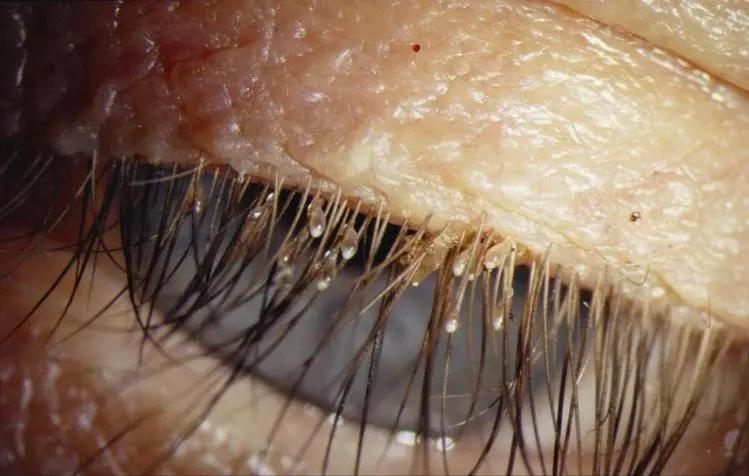 母女俩下腹瘙痒，医生用镊子夹出阴虱！原来阴虱有这4个传播途径