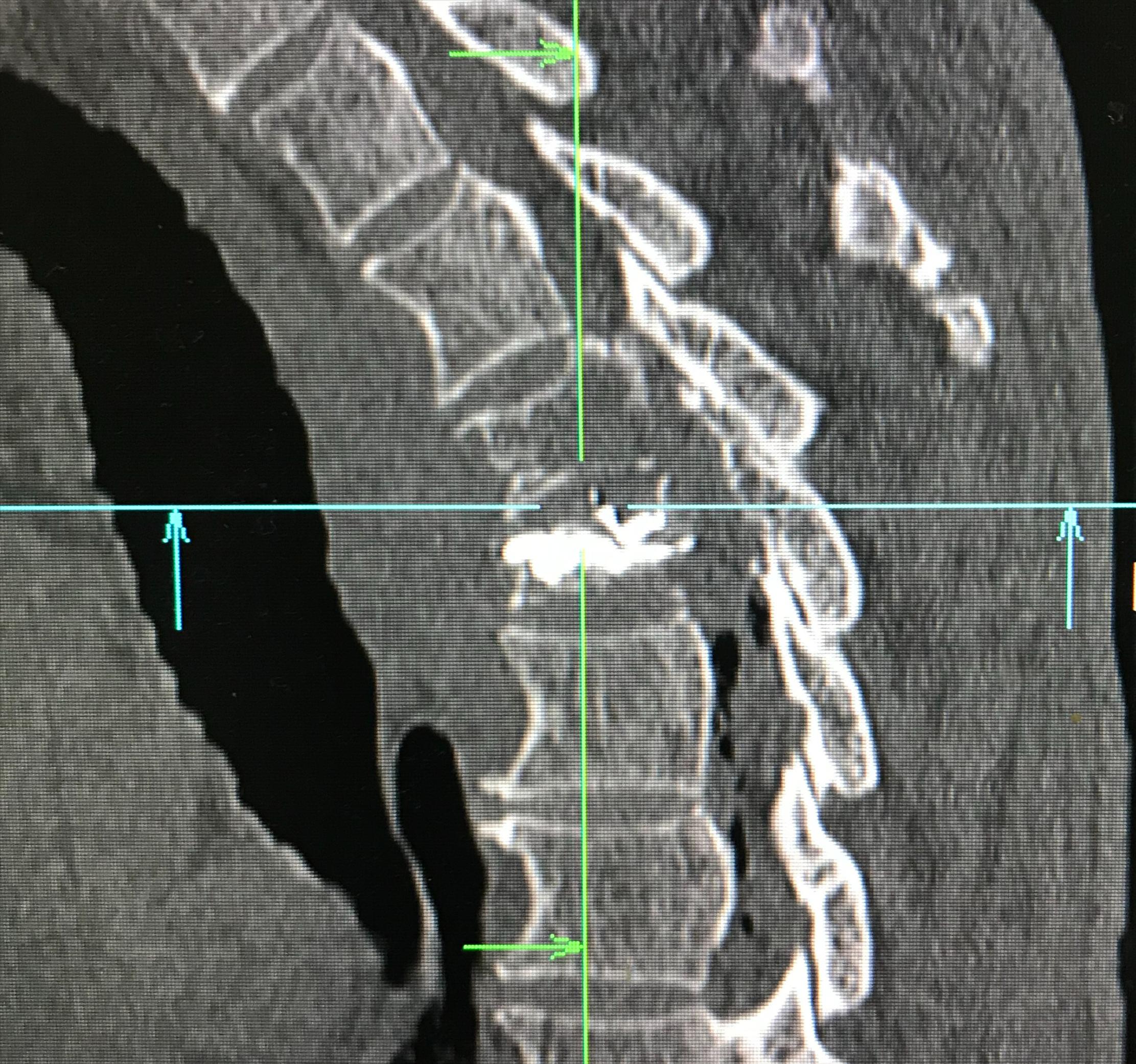 胸椎压缩性骨折微创手术利弊,胸椎压缩性骨折保守治疗20例