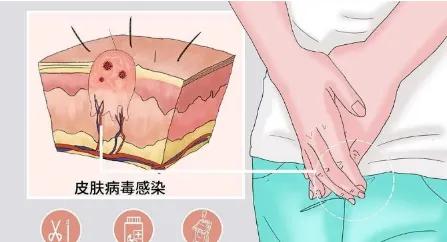 尖锐性湿疣是由哪几种hpv病毒引起,患了尖锐湿疣就一定有感染hpv病毒吗