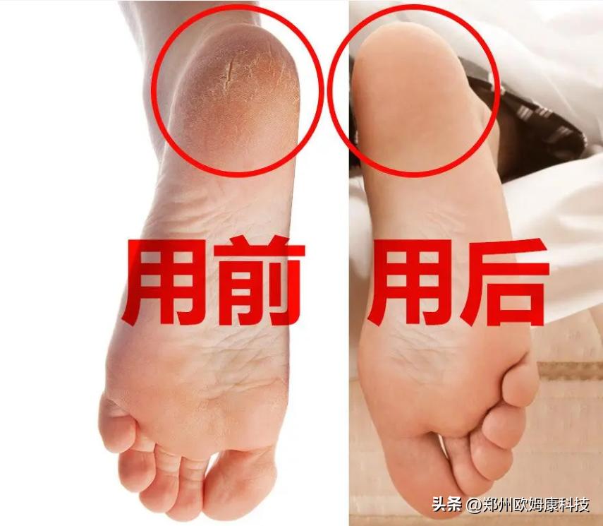 脚后跟干裂起硬皮防裂袜,纯棉防裂袜子防脚后跟干裂