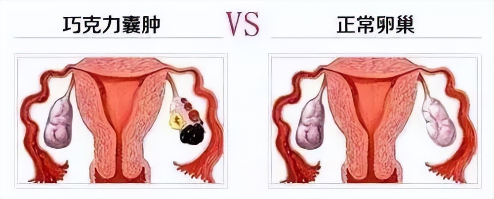 什么是卵巢囊肿？导致卵巢囊肿的原因有哪些？如何预防卵巢囊肿？