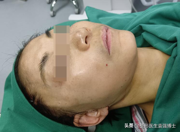 57岁脸又瘦又松，从广州来北京做大拉皮，即刻照镜子“没敢认”