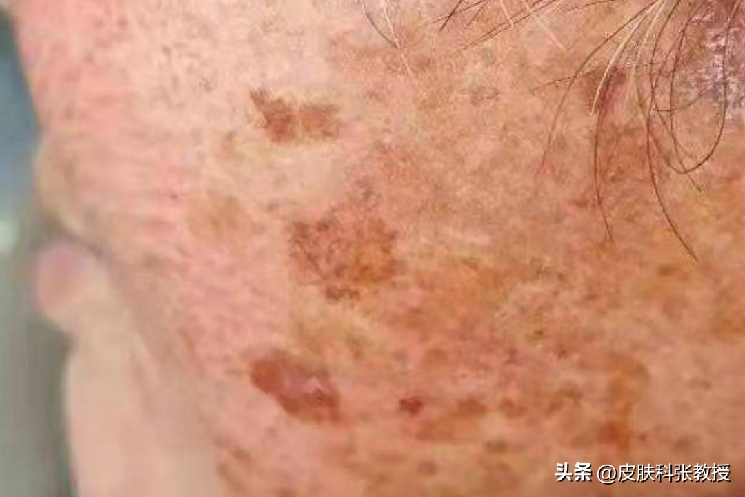 常年吃药造成脸上有斑怎么治,怎么判断脸上黑点是痣还是斑