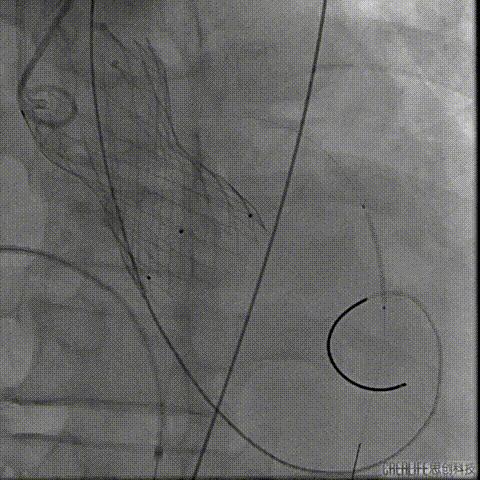 病例回顾与分享,腹膜后血肿介入治疗