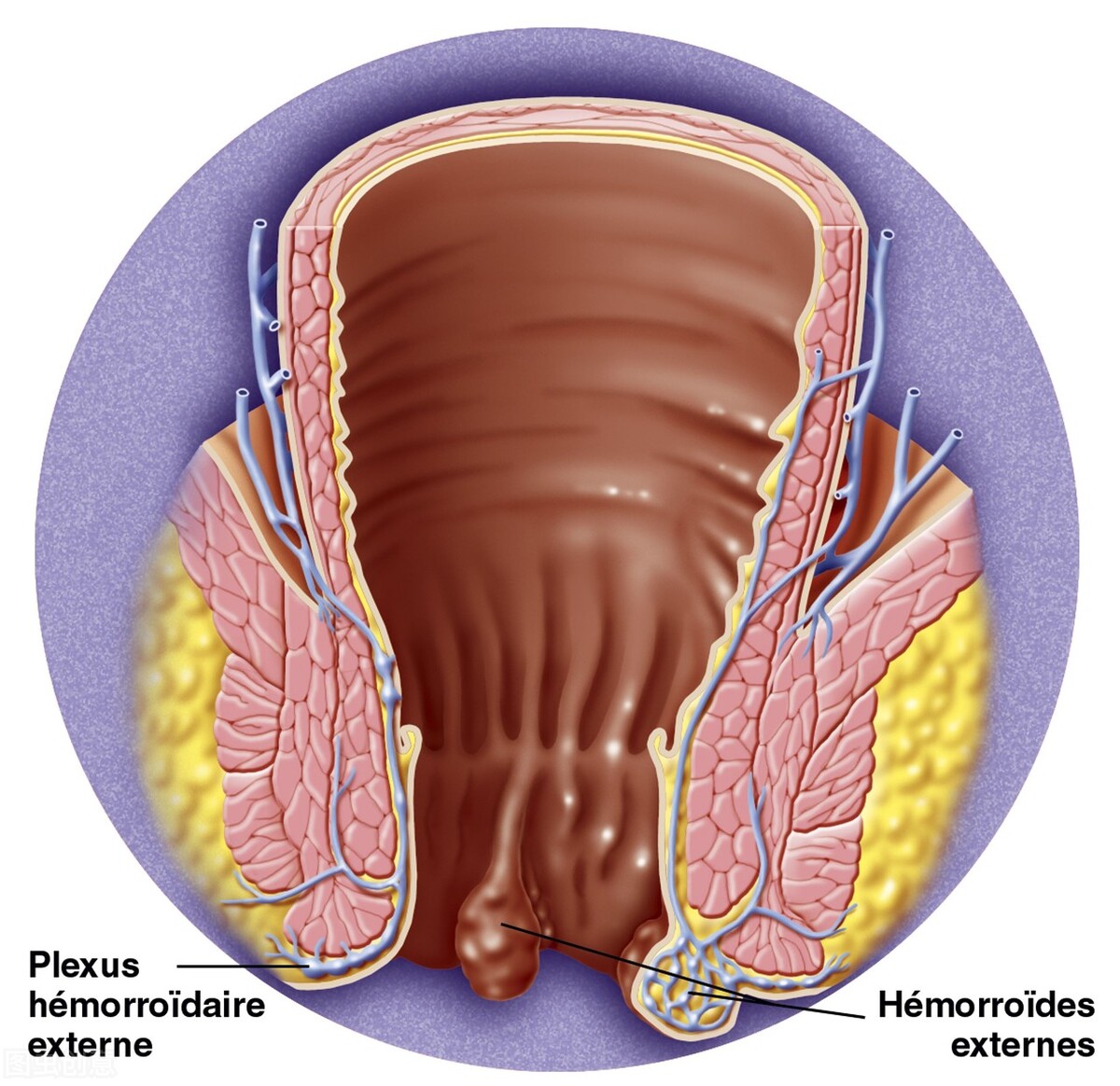 肛周脓肿能成为瘘管吗,肛周脓肿和痔疮有什么区别