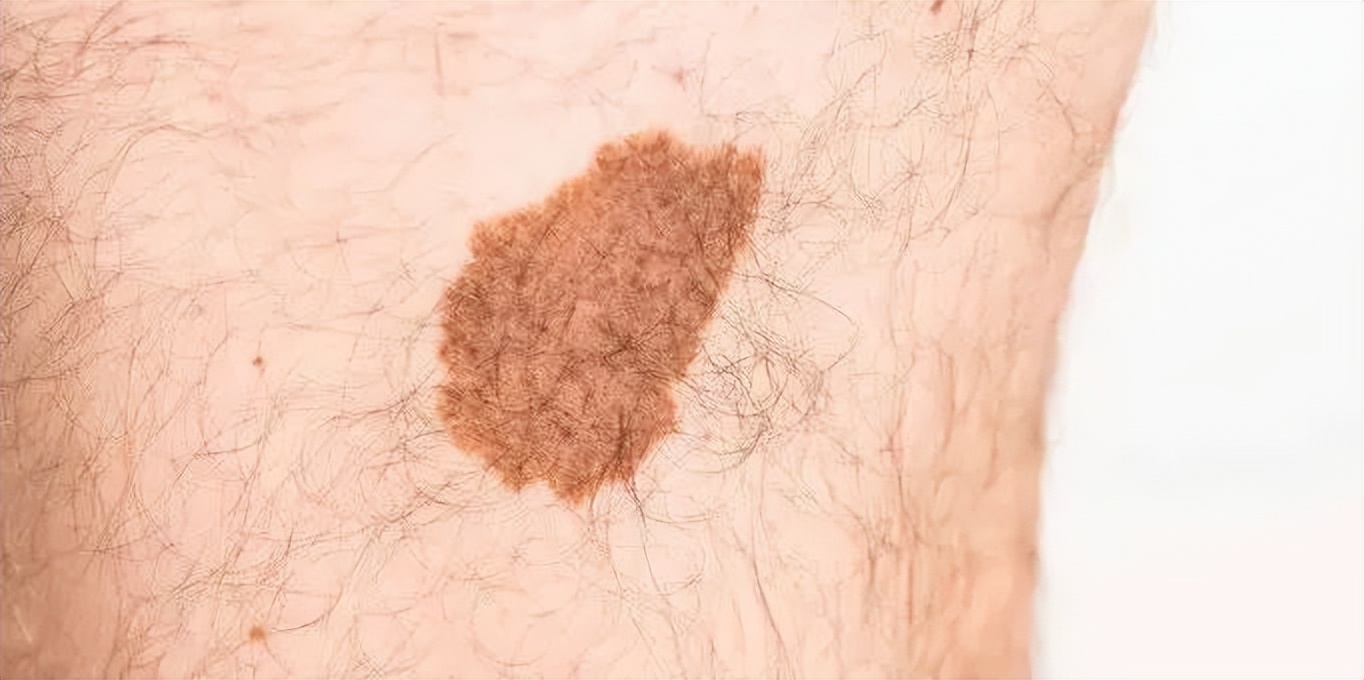 脸上长了很多痣是不是肝癌,这种痣可能是肝癌信号