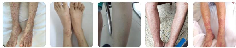 治紫癜别急着用药，先弄明白这些，盲目治疗不可取！