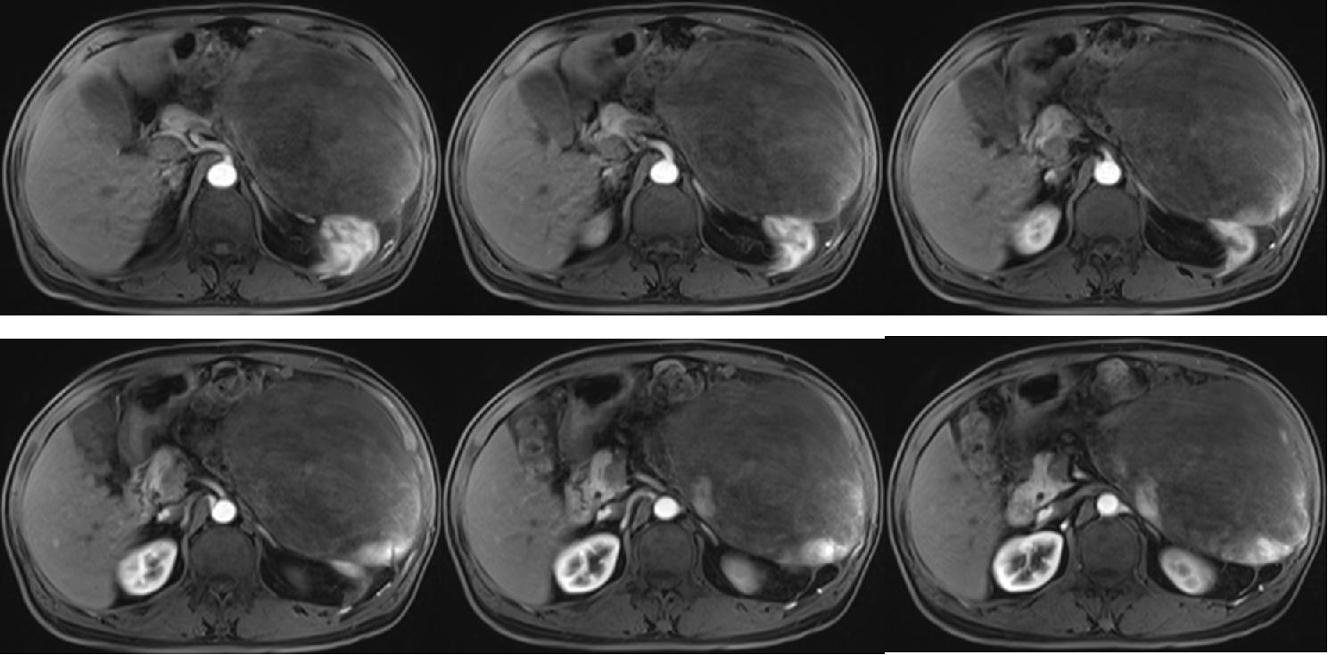 腹膜梭形细胞瘤怎么治,腹腔梭形动脉瘤严重吗