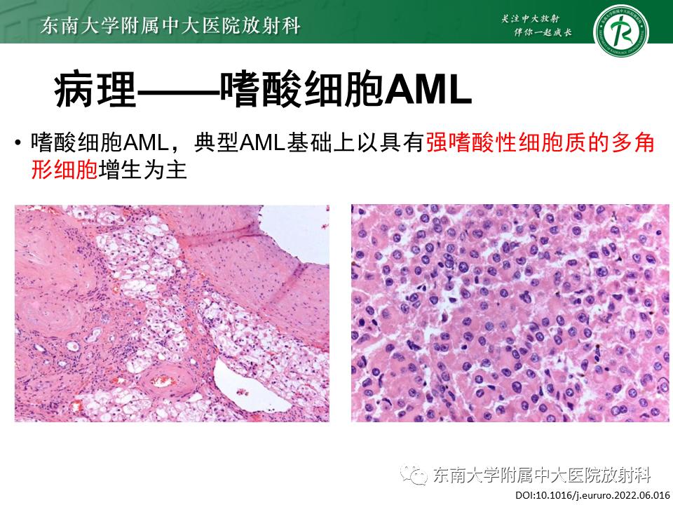 好文分享——《肾血管平滑肌脂肪瘤》