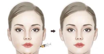 面部吸脂会影响酒窝吗,面部吸脂多久彻底消肿