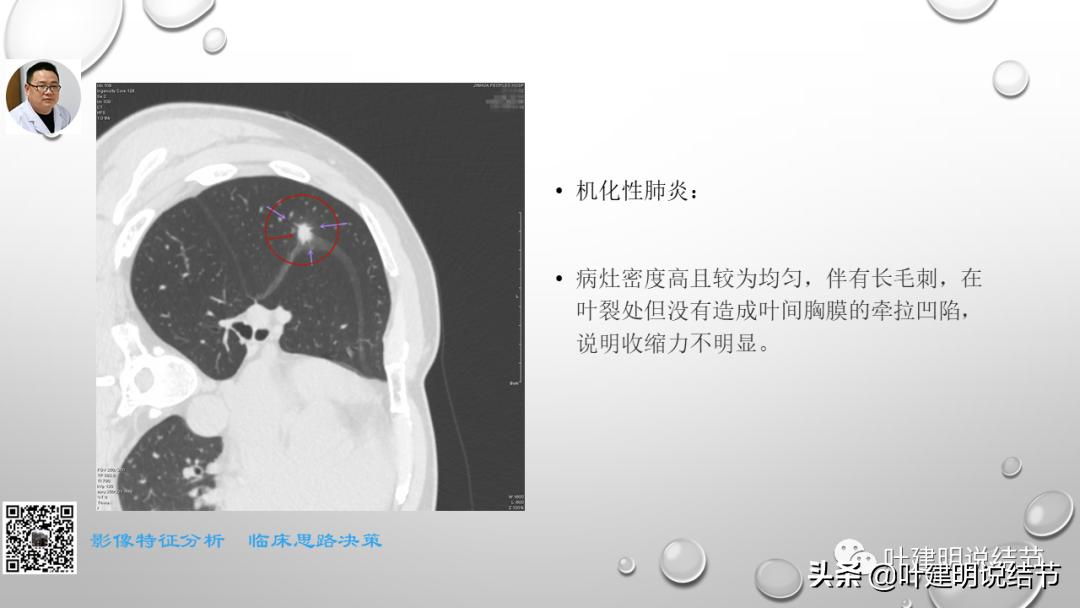 在《一脉阳光》呼吸影像诊断专题培训班上的讲课PPT（第一部分）