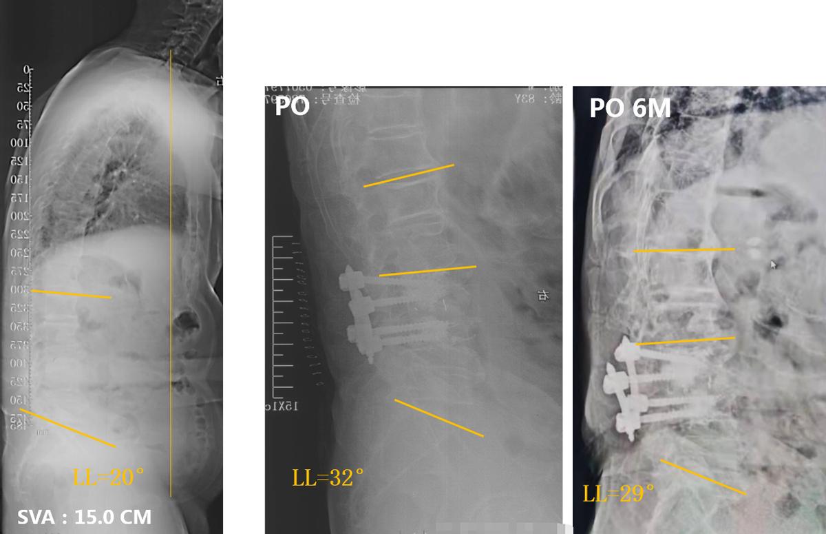 老年人脊柱侧弯的危害和症状,老人脊柱侧弯腰部疼痛怎么缓解