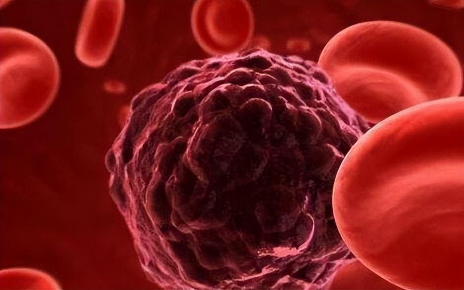 恶性淋巴瘤切除后化疗还是放疗,恶性肿瘤化疗和放疗的区别