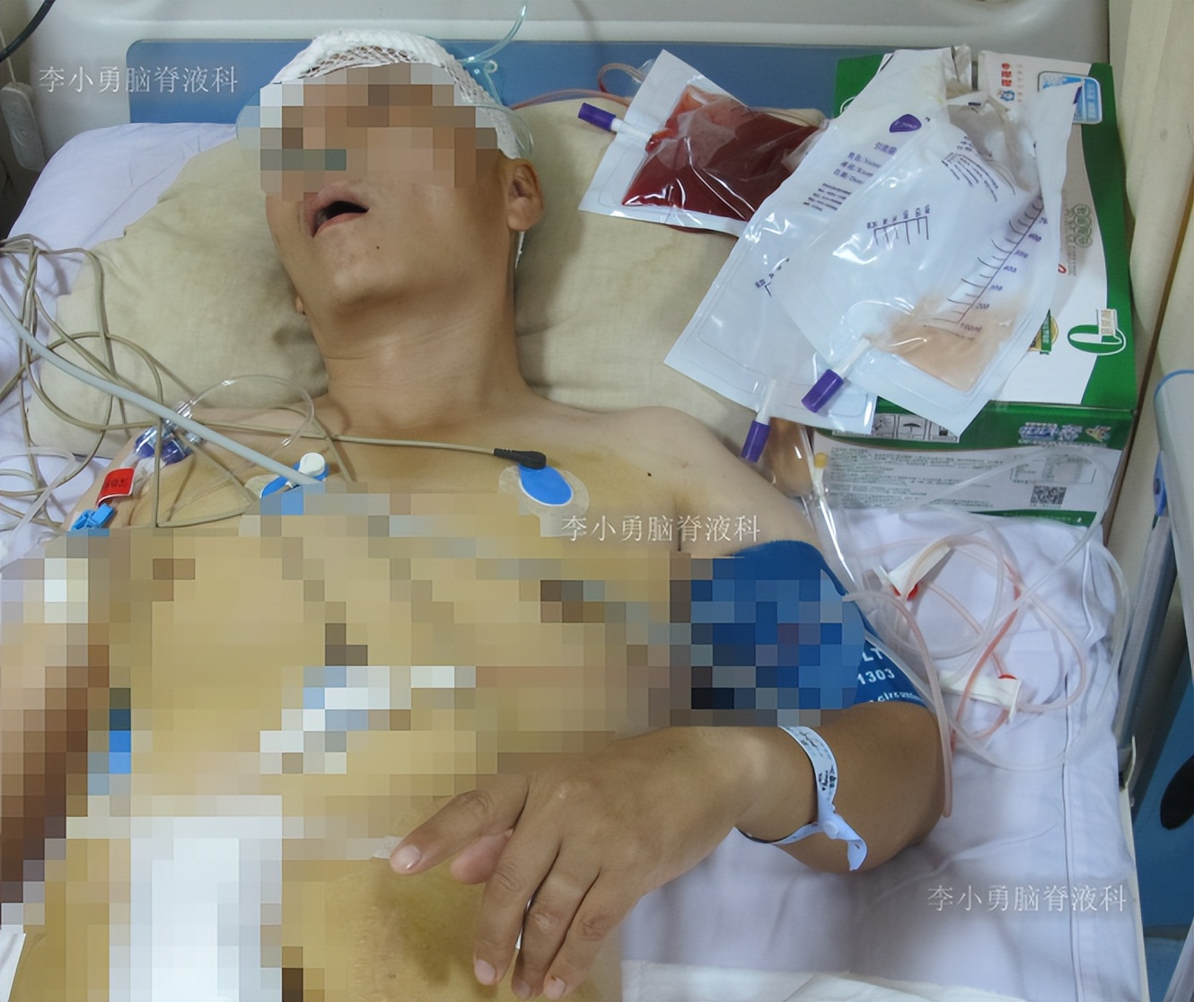 脑积水三脑室造瘘多久能恢复,脑囊虫手术后脑积水