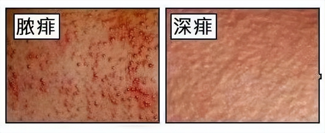 生活中最常见的4种皮肤病,皮肤科可以看多种皮肤病吗