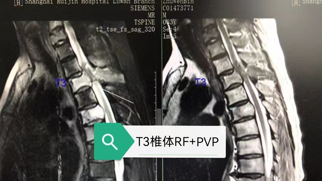 病例Ⅴ：RF+PVP联合治疗高位胸椎溶骨性转移瘤及压缩骨折