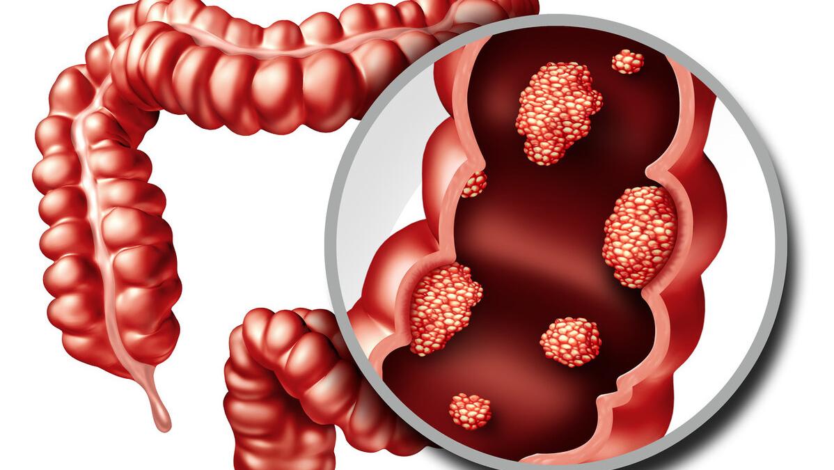 拉稀也会得痔疮,拉稀久了长痔疮怎么办