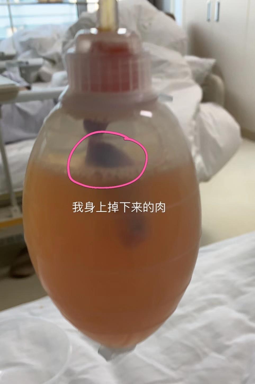小有名气的大夫说，我是他治过最严重的乳糜漏。竟莫名有些自豪？