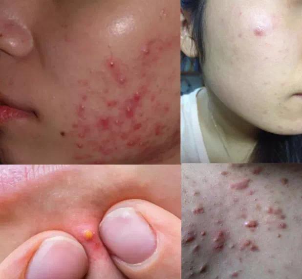 为什么二十岁开始疯狂长痘,一个人反反复复长痘什么原因