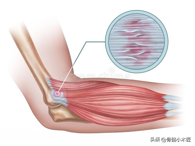 外伤肱骨外上髁炎,运动损伤的骨膜炎怎么治