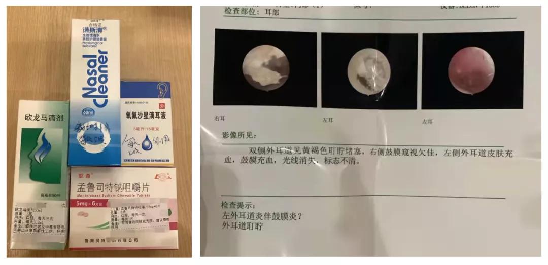 儿童中耳炎是怎么导致的耳朵疼,小孩中耳炎如何缓解耳朵疼痛