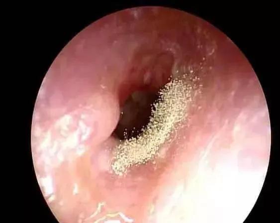 为什么有的人喜欢掏耳屎,喜欢掏耳屎是一种病态吗