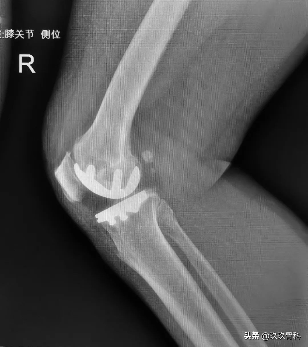 贵阳东方骨科医院膝关节置换,骨科单髁置换手术