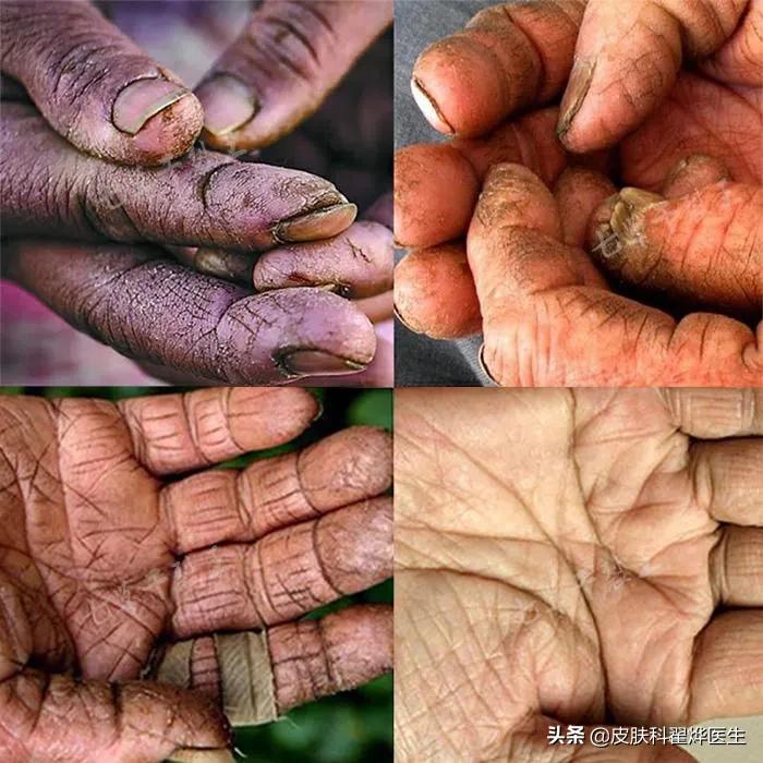 父母手皲裂用什么药,父母手脚皲裂