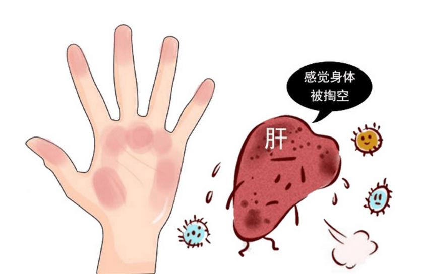 有红点很可能是肝病恶化了,出现这些红点可能是肝硬化