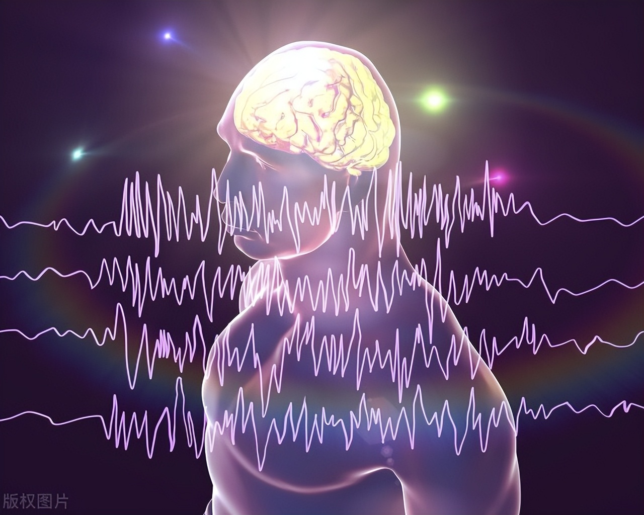 胶质瘤引起的癫痫是什么癫痫,胶质瘤与癫痫