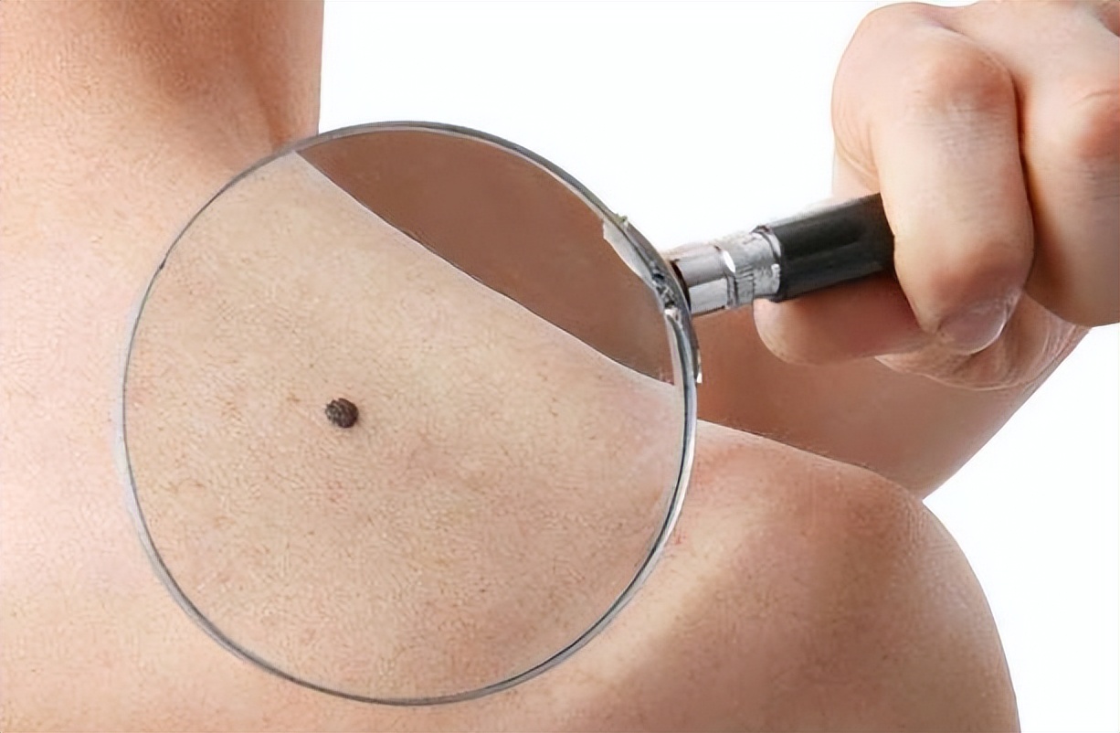 容易引起癌变的痣，需要警惕。