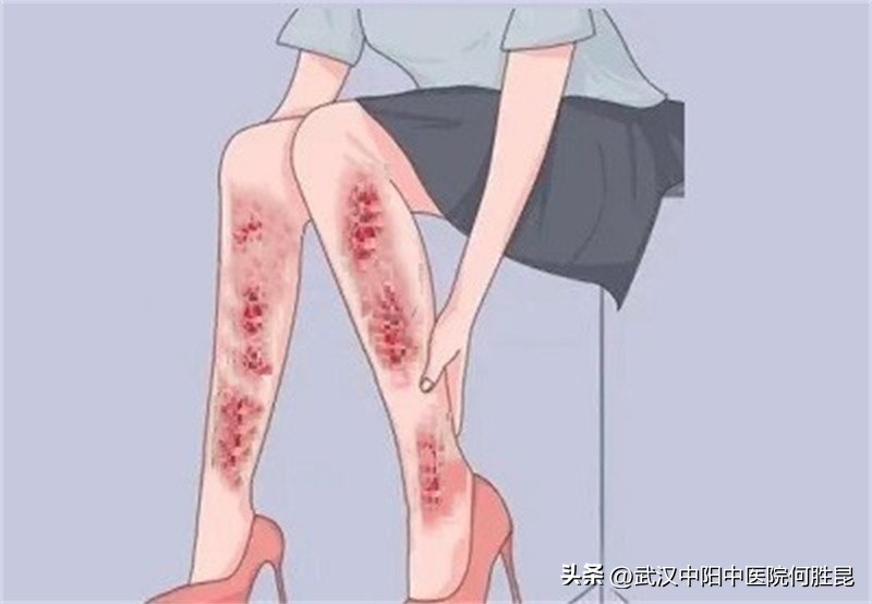 腿上起了红斑而且还起皮,腿上皮肤出现大片的红斑