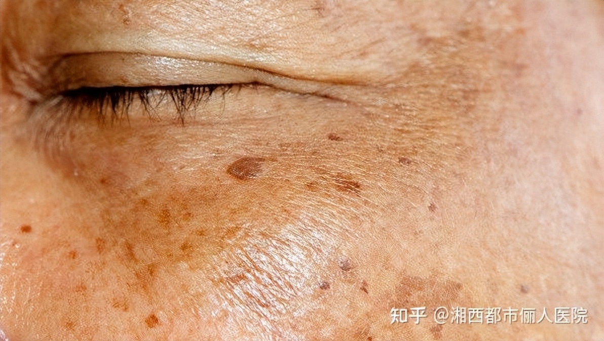 褐斑怎么去除才可以清除掉,褐斑怎样才能彻底的去掉