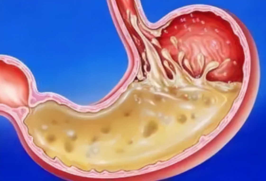 医生：这些病可能是“撑”出来的，饿一饿就行了？吃太撑咋办？