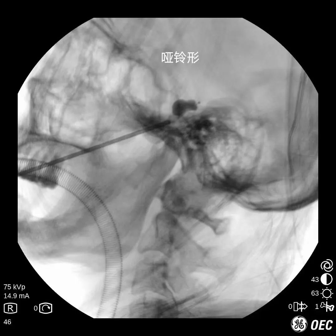 临汾治疗三叉神经痛多少钱,临汾市最好的三叉神经痛医院