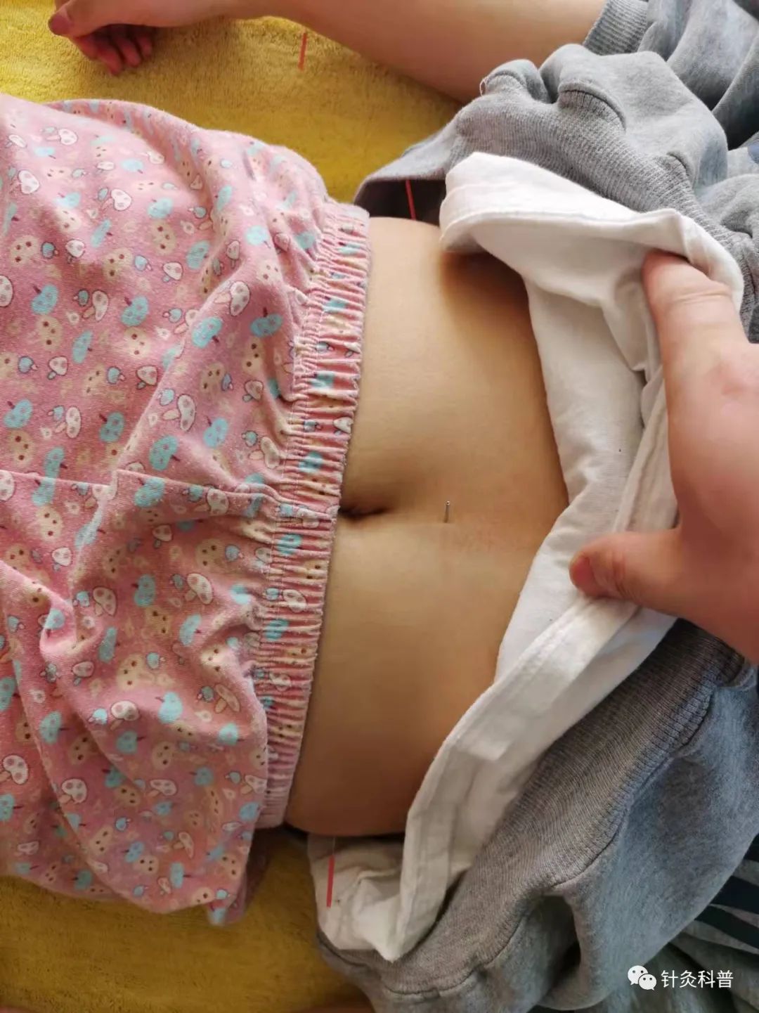 针灸治病治愈案例,针灸治疗妇科杂病视频