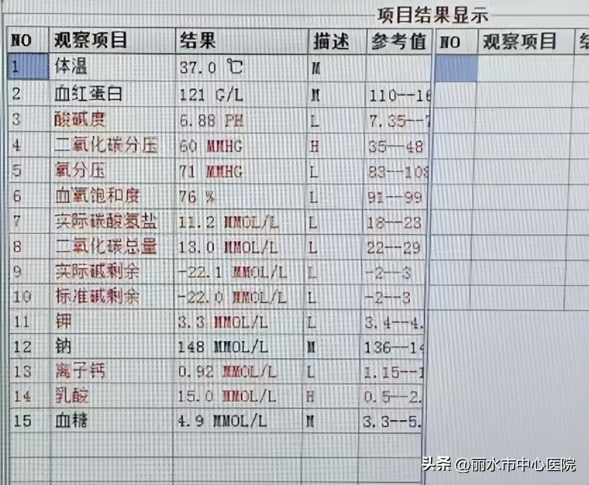 ecmo联合crrt治疗的连接方式,急性心肌梗死ecmo治疗