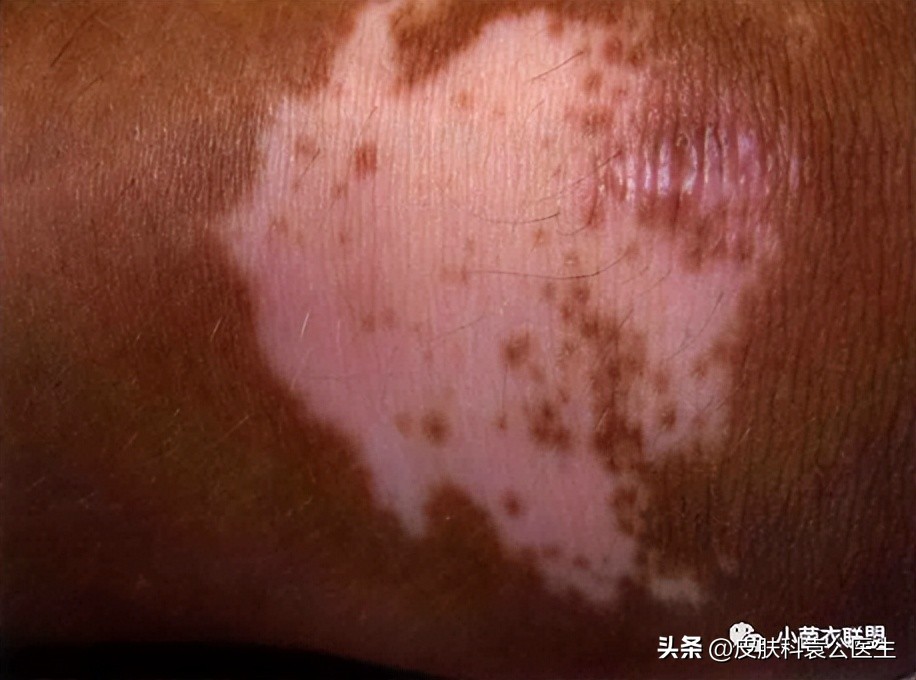 皮肤病忌口发物都包括牛奶吗,发物忌口期间吃什么比较好