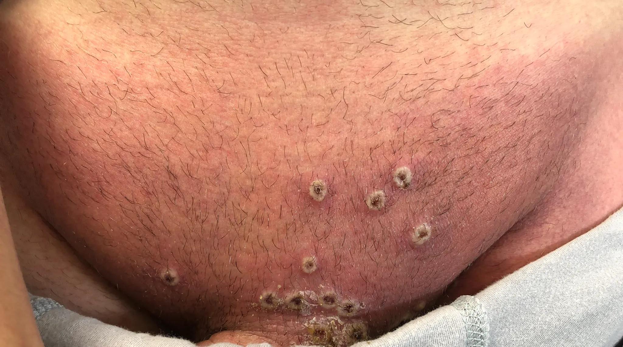 猴痘已在欧洲传播,欧美国家爆发猴痘疫情了吗