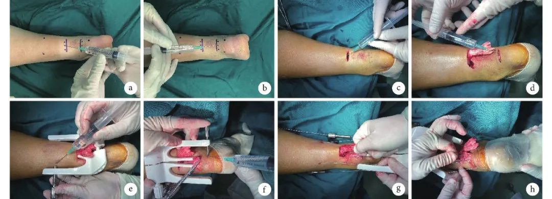 跟腱断裂麻醉方式,跟腱断裂手术可以局部麻醉吗