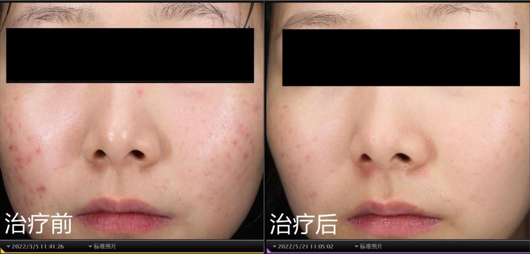 痘印痘坑最佳解决方案,磨痘坑